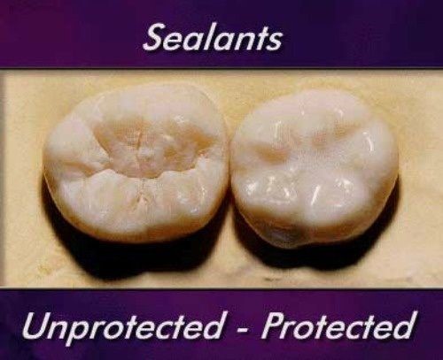 Image of Dental Sealants